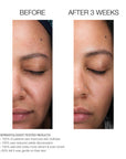 Lactic Acid Retexturing Micro-Peel