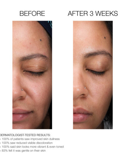 Lactic Acid Retexturing Micro-Peel