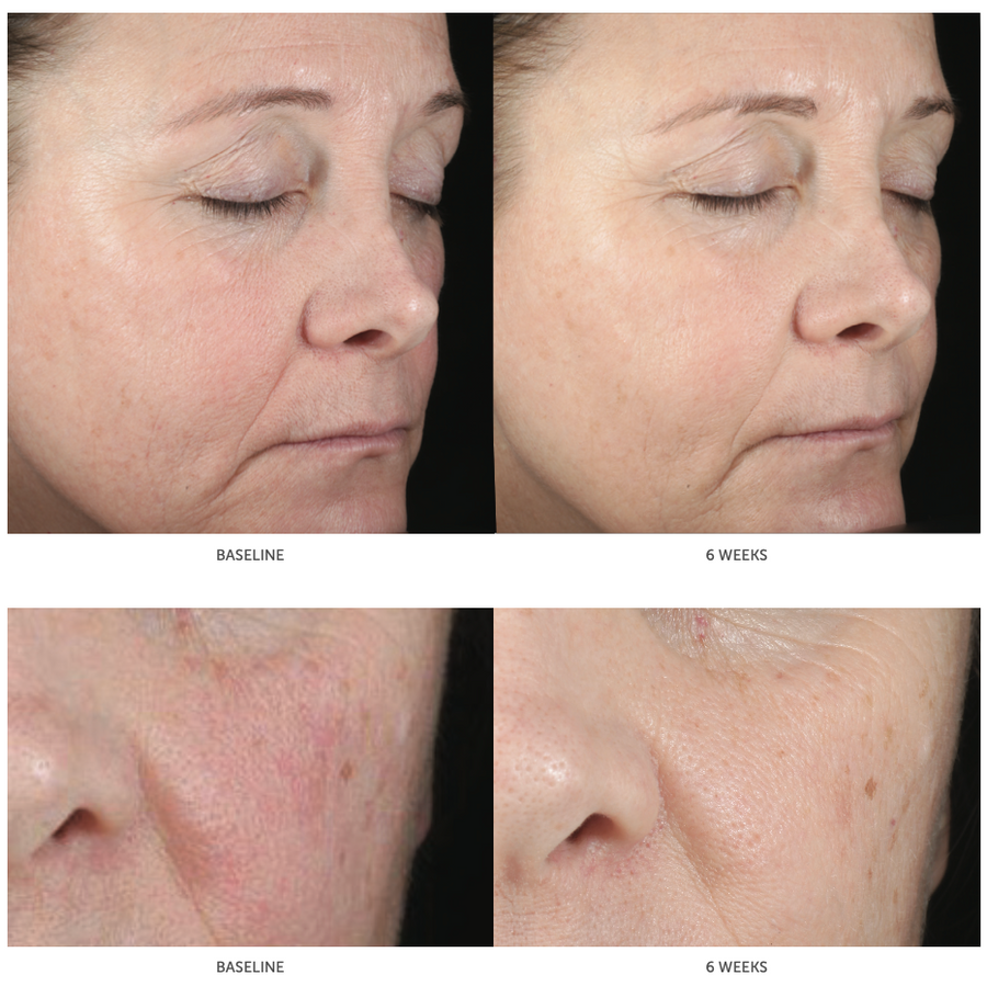 Hyaluronic Acid Serum Before After